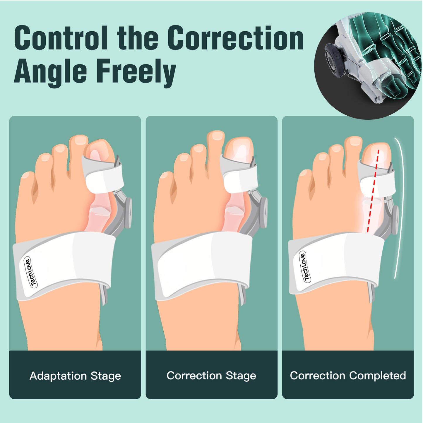 Adjustable Bunion Corrector for Women and Men, Orthopedic Bunion Toe Straighteners, Big Toe Brace for Hallux Valgus, Adjustable Bunion Splint with Silicone Inner Pad for Bunion Relief-1 PC